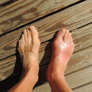 Gout and Prostate Problems