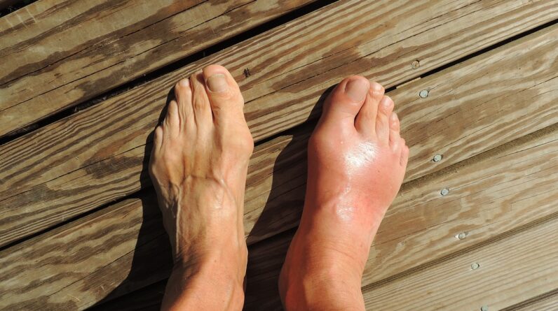 Gout and Prostate Problems