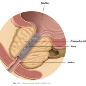 Stent For Prostate