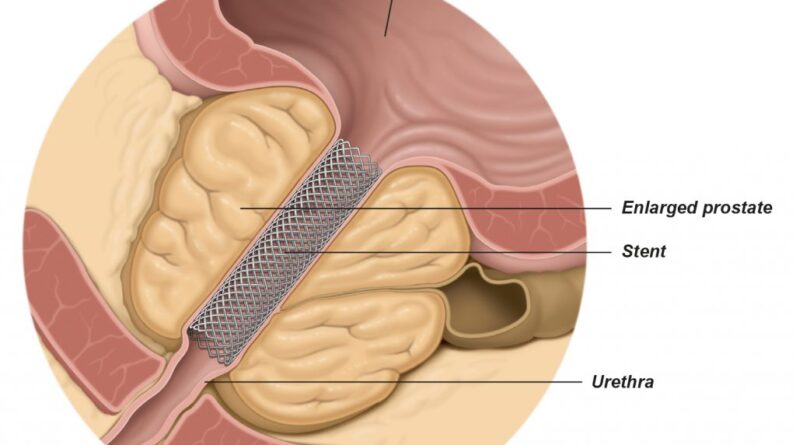 Stent For Prostate