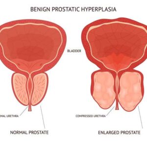 Enlarge Prostate