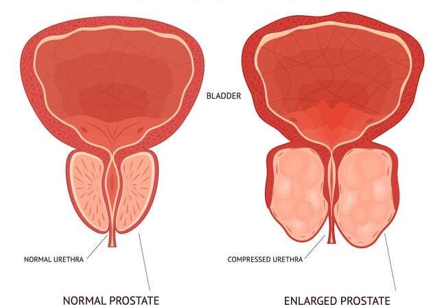 Enlarge Prostate